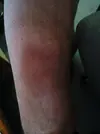 bruse patern left forarm 2.webp