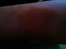 bruse patern left forarm.webp