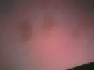 bruse patern right thigh.webp